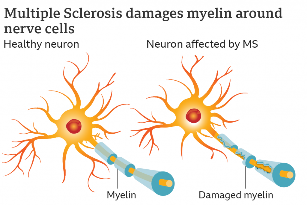 multiple sclerosis stem cell treatment
